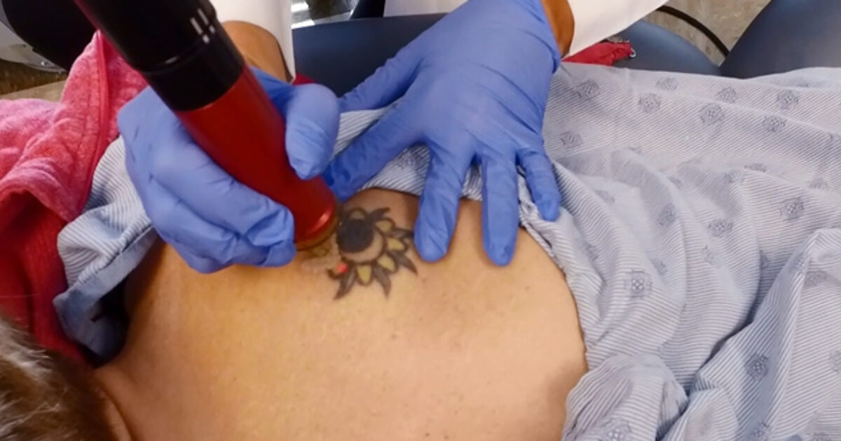 The Rise in Tattoo Removal IU Health