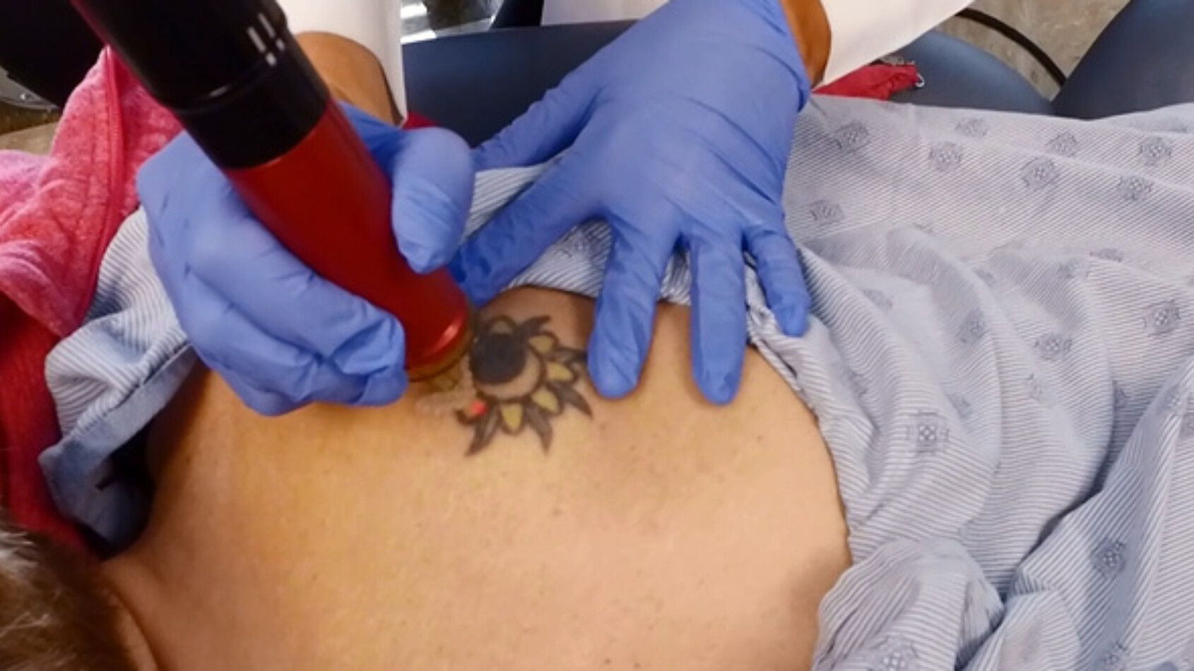 The Rise in Tattoo Removal IU Health