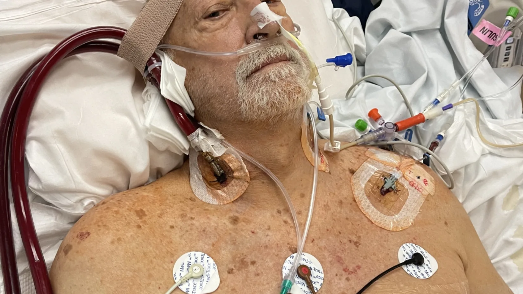 Patient sidelined by lung transplant hopes to continue traveling the world