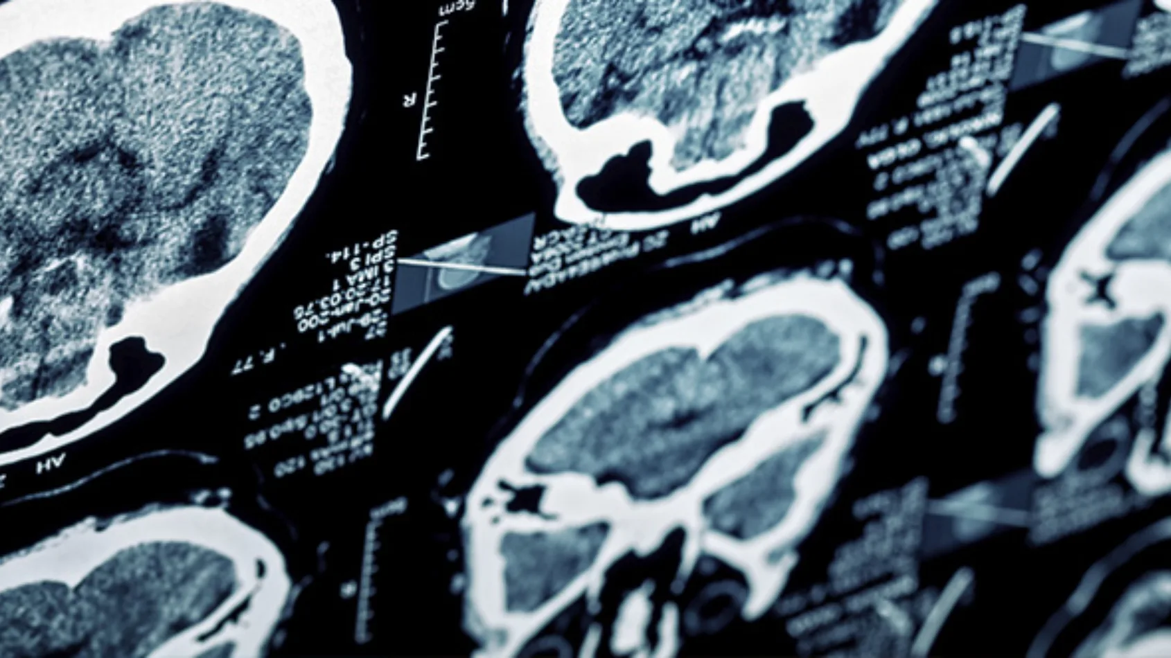 B.E.F.A.S.T. because strokes can happen at any time and at any age