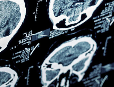 B.E.F.A.S.T. because strokes can happen at any time and at any age