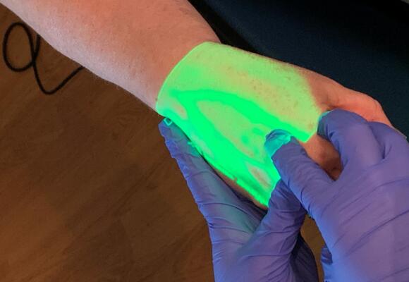 IU Health White Memorial adds VeinViewer