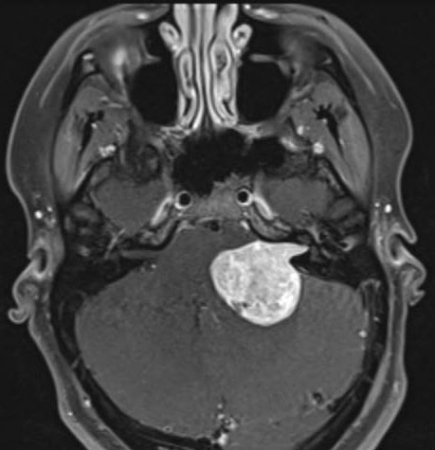 Acoustic Neuroma