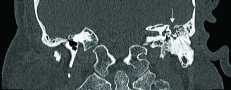 spontaneous cerebrospinal fluid leak specialist spontaneous cerebrospinal fluid leak specialist