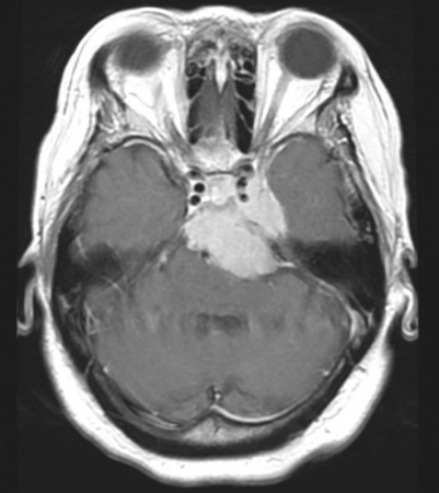 Meningioma