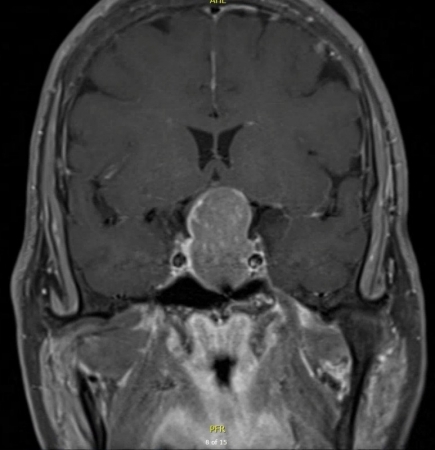 Pituitary Adenoma