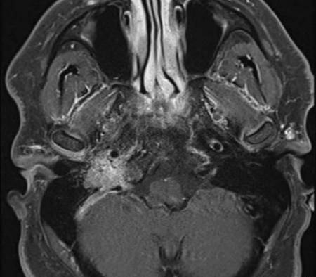Glmous Tumor
